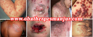 Illustration for article titled cara menyembuhkan herpes